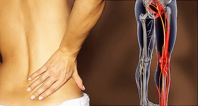 sciatica , Back Pain relief with Physiotherapy